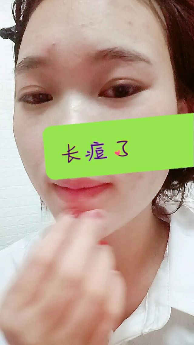 手机版祛痘的小游戏_手机清痘游戏_我要玩祛痘的游戏