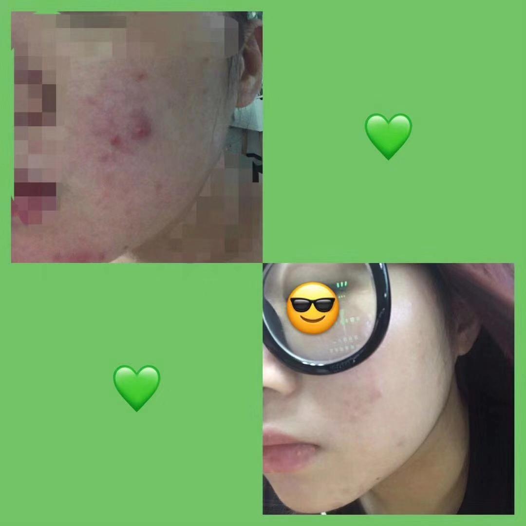 我要玩祛痘的游戏_手机版祛痘的小游戏_手机清痘游戏